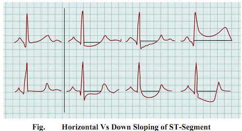 1466_Show Upsloping ST-Segment1.png